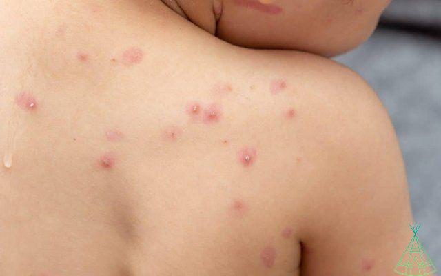 Est-ce la variole ou la varicelle ? Savoir différencier